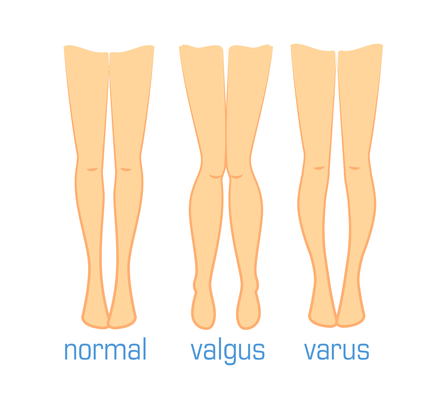 Вальгус и варус. Стопы рисунок ноги вальгус Варус.